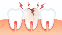 10 Penyebab Sakit Gigi dan Cara Mengobatinya