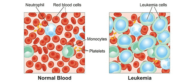 Kenali Gejala, Penyebab, Jenis dan Pengobatan Leukimia