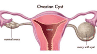 Kenali Penyakit Kista Ovarium : Pengertian, Jenis, Gejala dan Penyebabnya