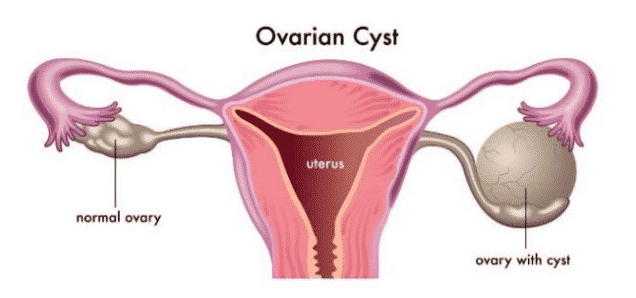 Kenali Penyakit Kista Ovarium : Pengertian, Jenis, Gejala dan Penyebabnya